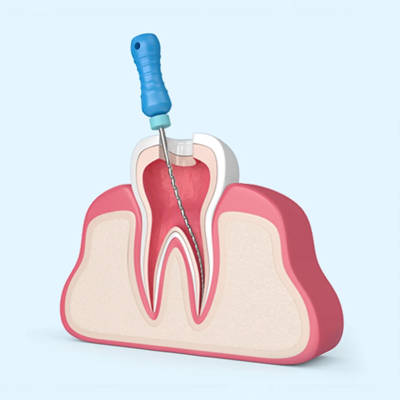 Root canal treatment for dental abscess