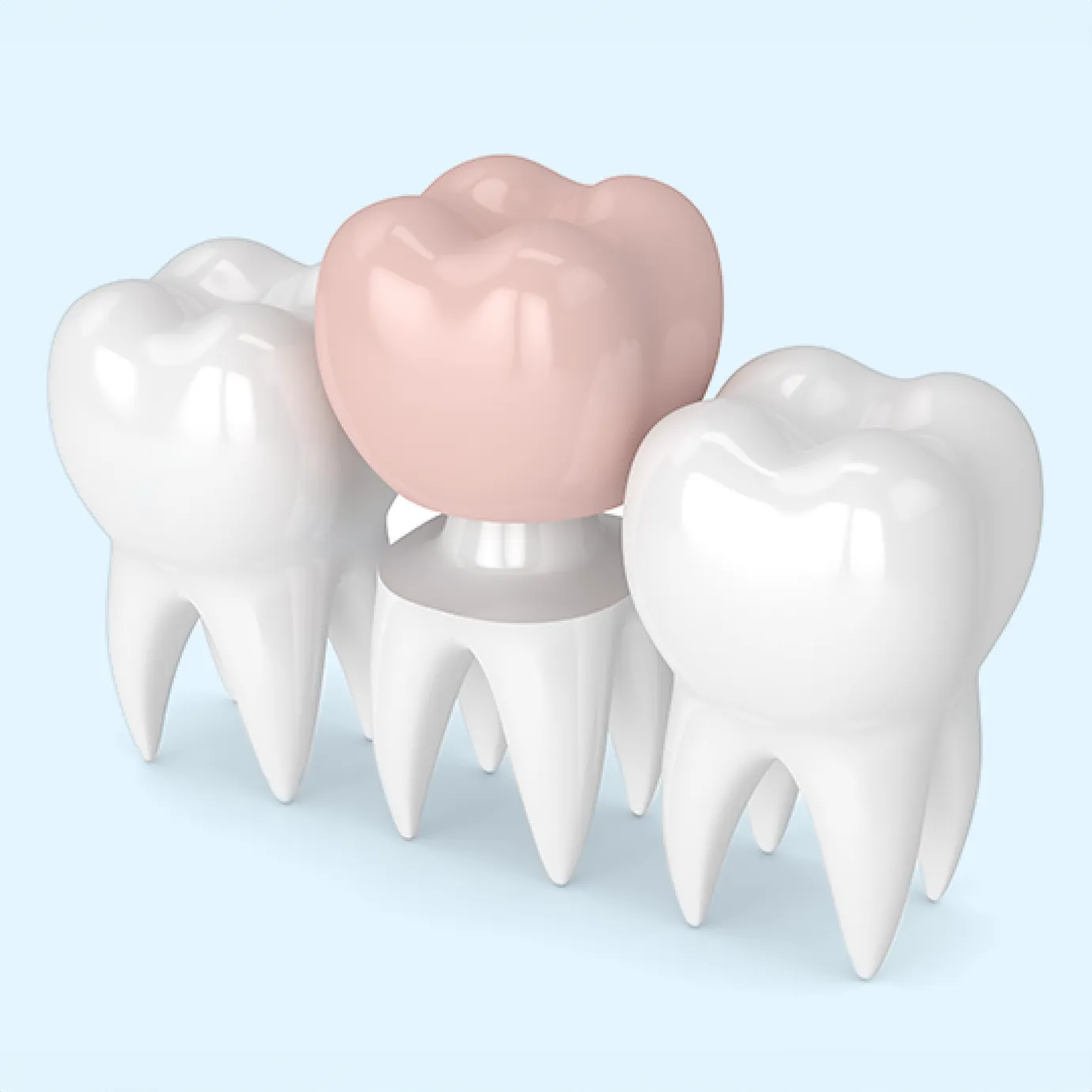 Dental crown replacement
