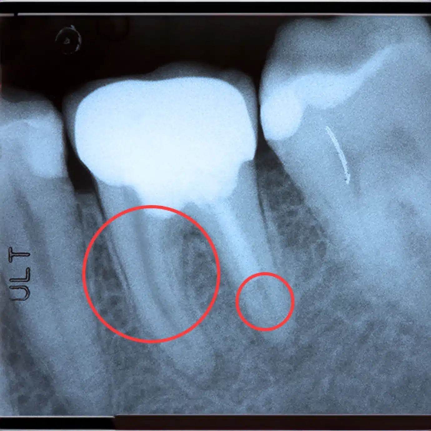 TIP: What to look for in root canal treatment?