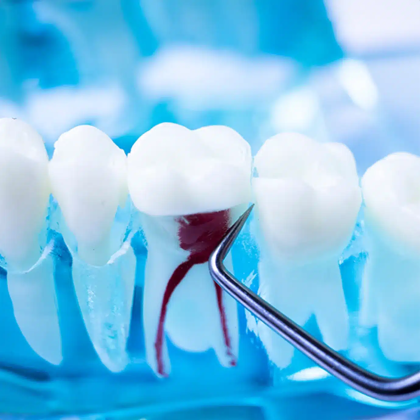 When is root canal treatment needed?