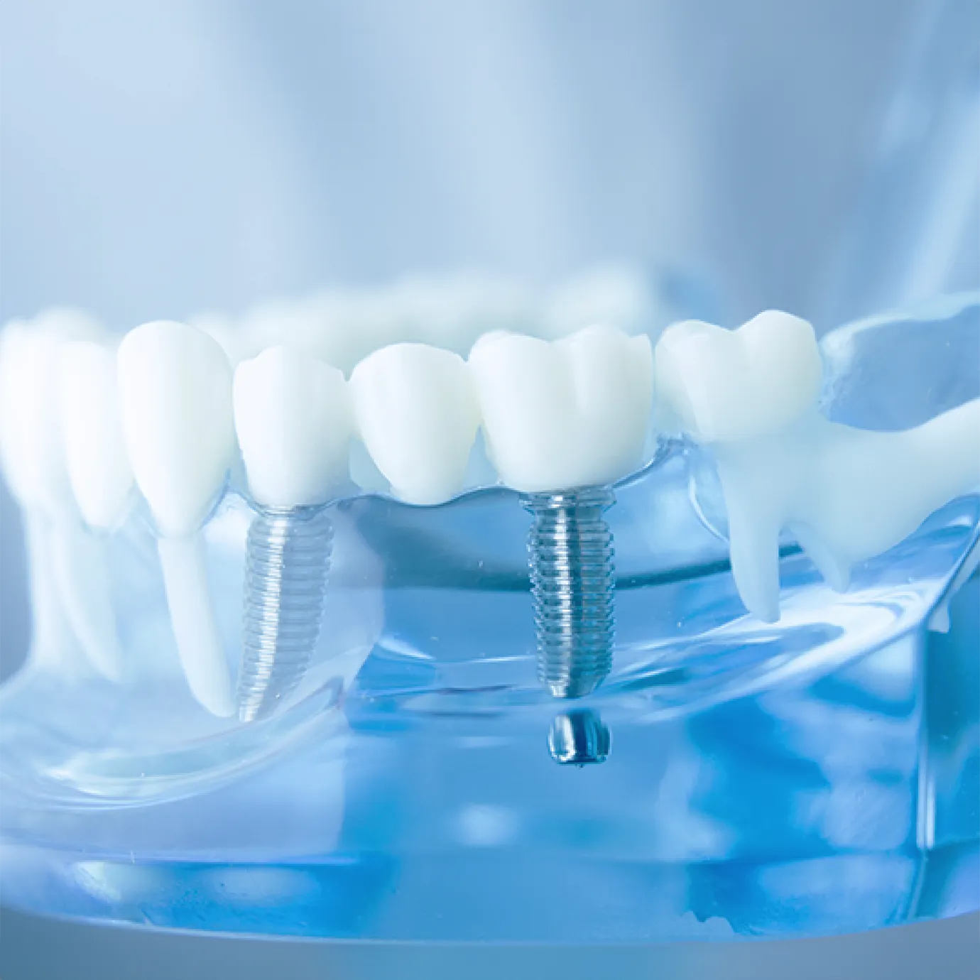 Emergency dental implants treatment