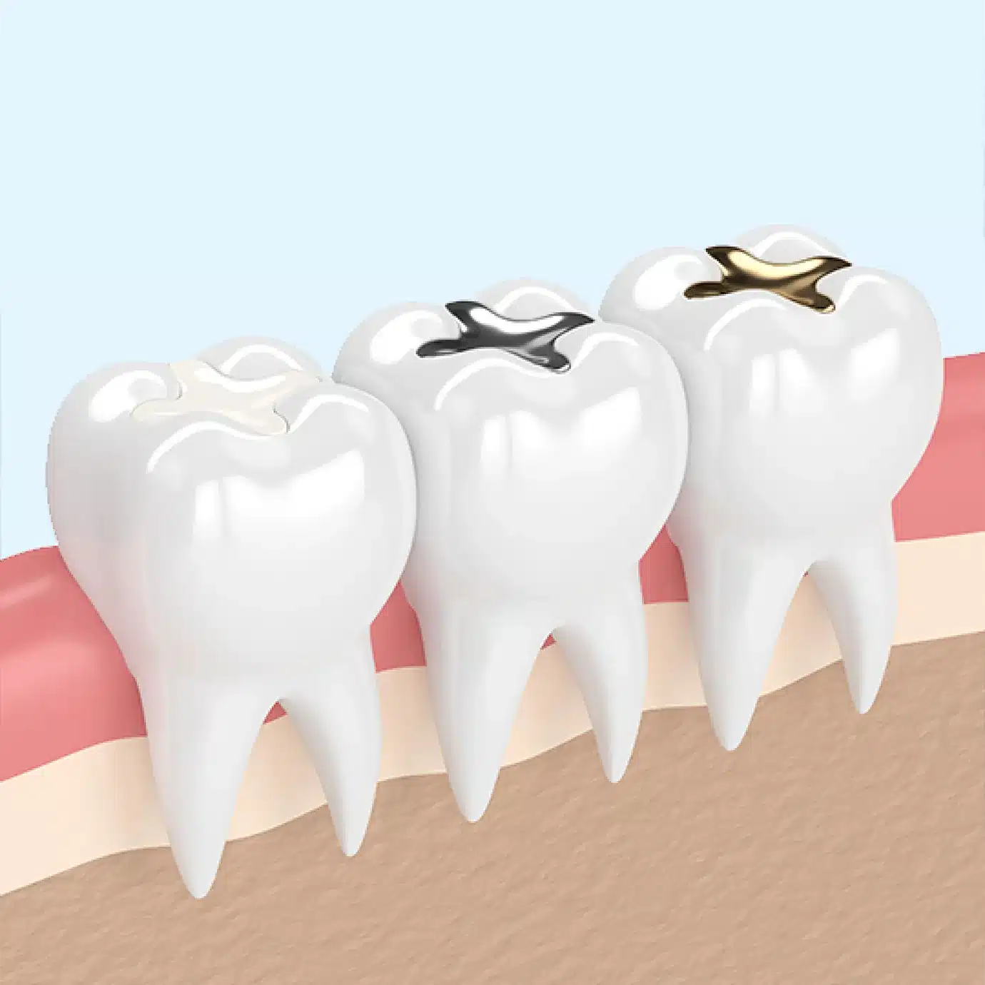 Silver Fillings vs White Fillings: What is Different?