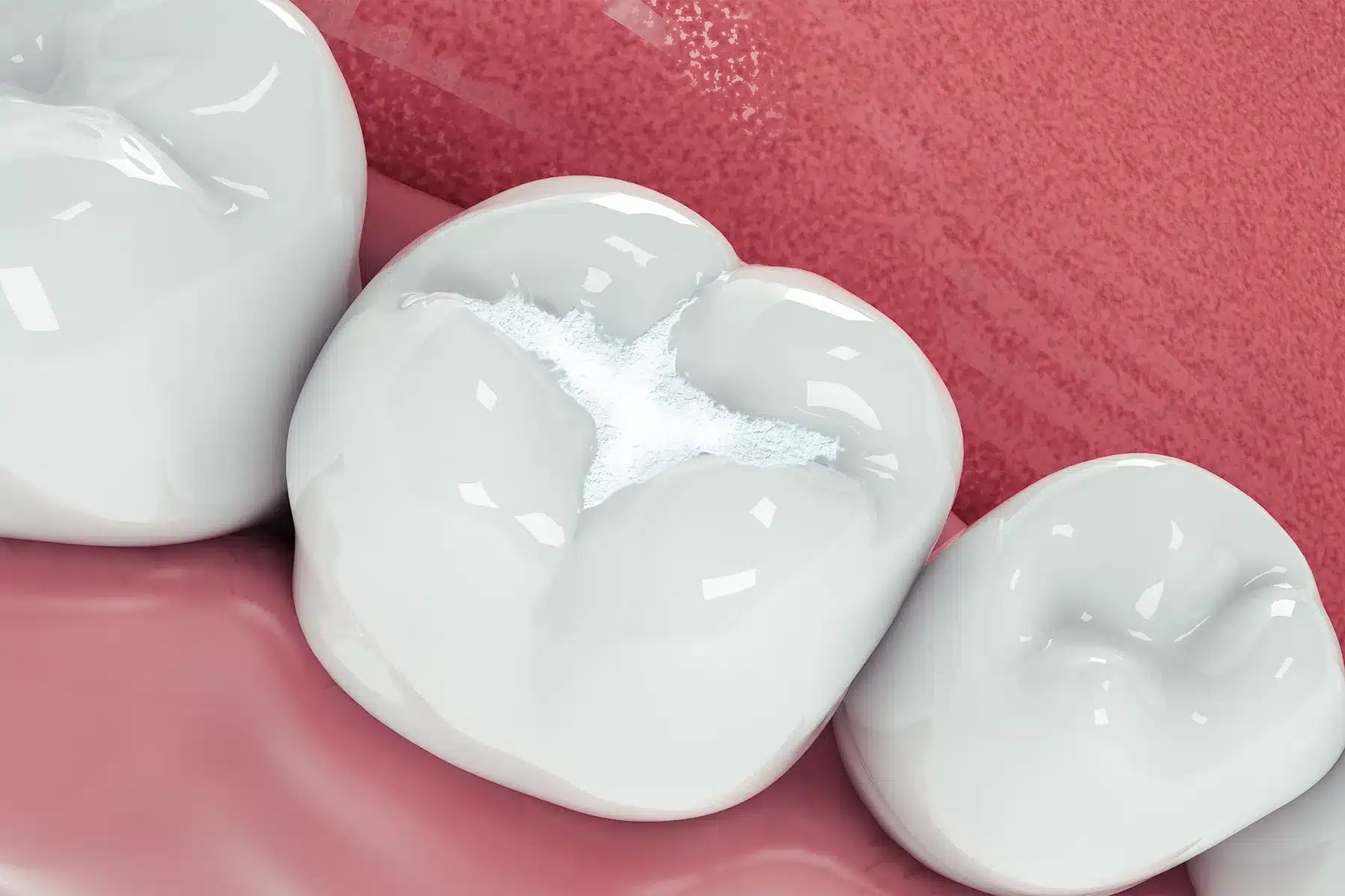 Should you replace your silver fillings with white fillings?